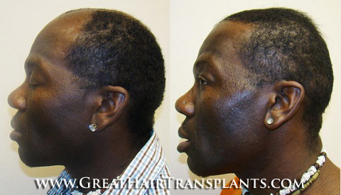 hair transplant surgery