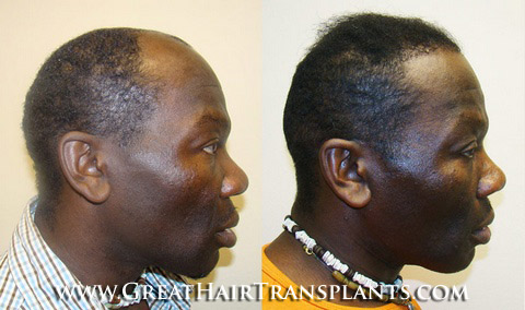 hair transplants cost