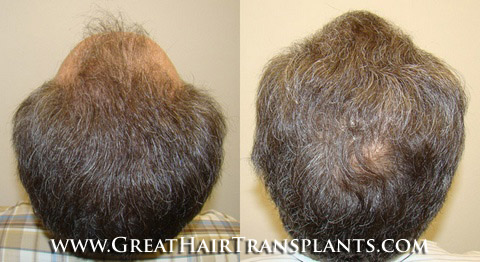 hair transplant cost