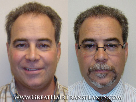 affordable hair transplants