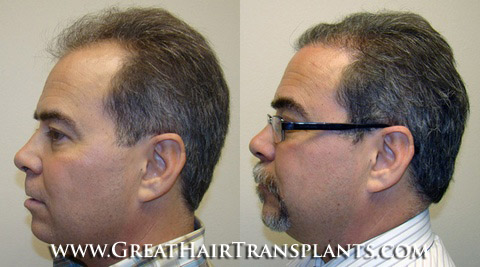 hair transplant