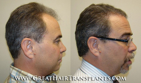 hair transplants cost