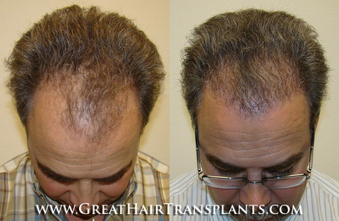 hair transplantation