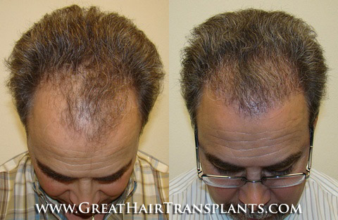 affordable hair transplants