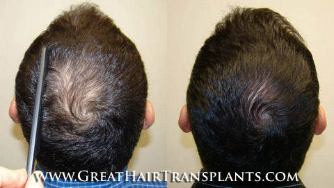 hair restoration