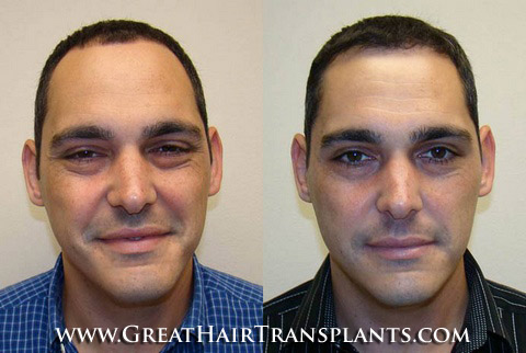 affordable hair transplants