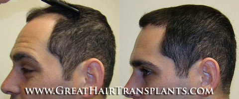 hair transplants