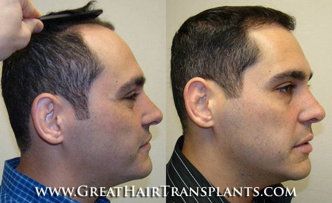 hair transplants cost