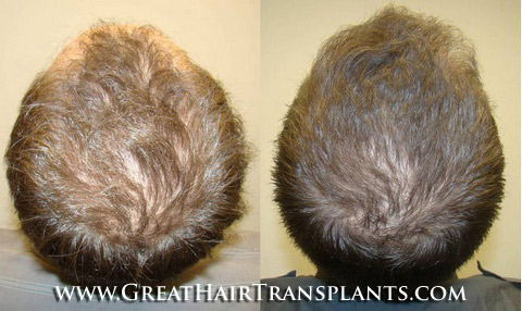 hair transplant