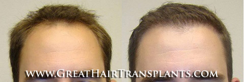 hair transplant