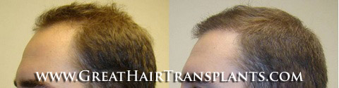 hair transplants cost