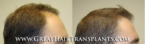 hair transplant