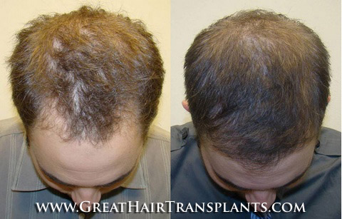 affordable hair transplants