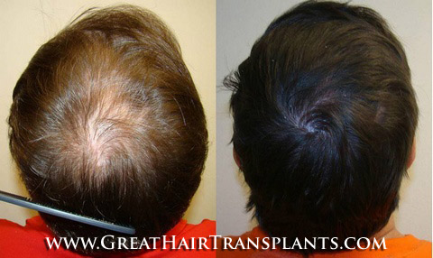 hair transplant