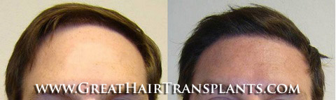 hair transplants cost