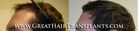 low cost hair transplants