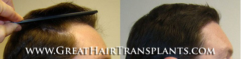 hair transplants cost