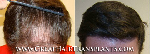 hair transplant