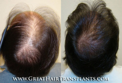 hair transplant