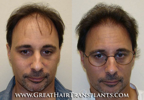 hair transplant surgery