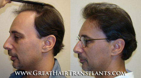 affordable hair transplants