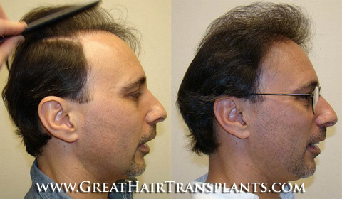 low cost hair transplants