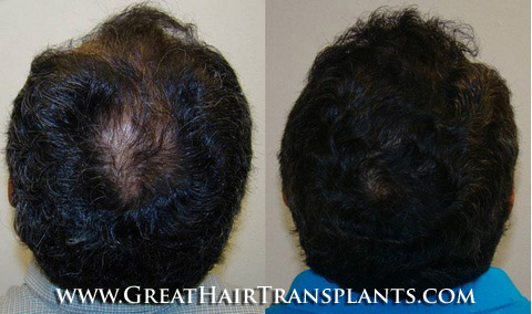 hair transplant