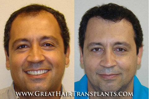 hair transplants