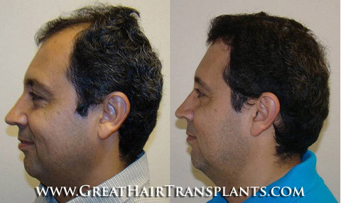 affordable hair transplants