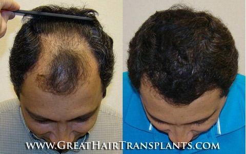 hair transplant