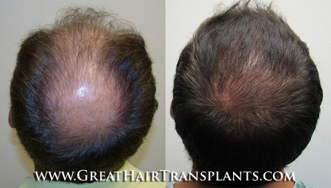 hair transplants cost