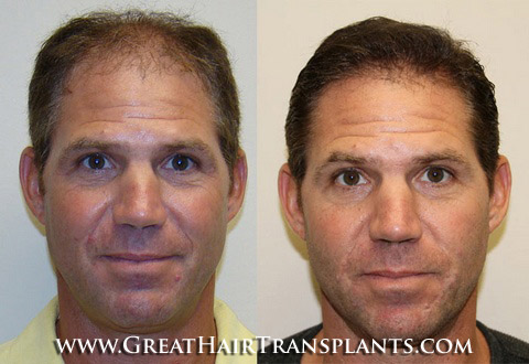 hair transplant cost