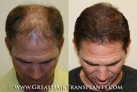 low cost hair transplant