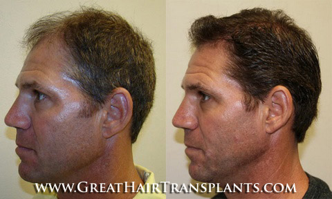 hair transplant surgery