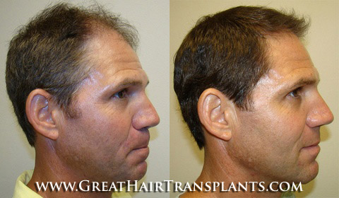 hair implant