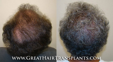 hair restoration