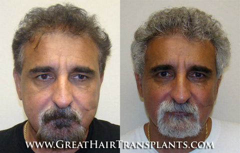 hair transplant surgery