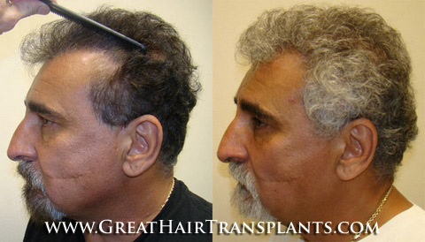 low cost hair transplants