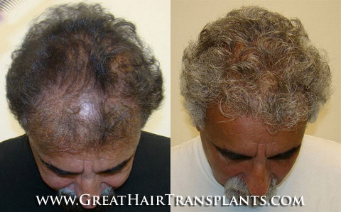 hair transplants cost