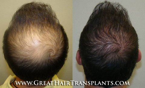 affordable hair transplants