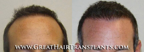 hair transplants cost