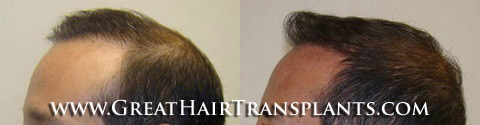 low cost hair transplant