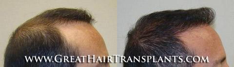 hair transplants