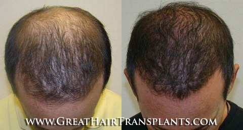 hair transplants