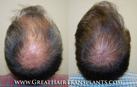 hair transplant