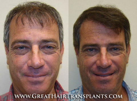 hair transplant