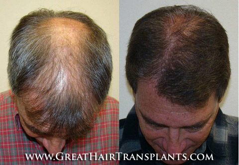 hair transplant surgery