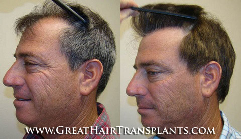 hair transplant