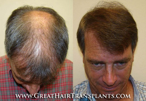 hair transplant cost