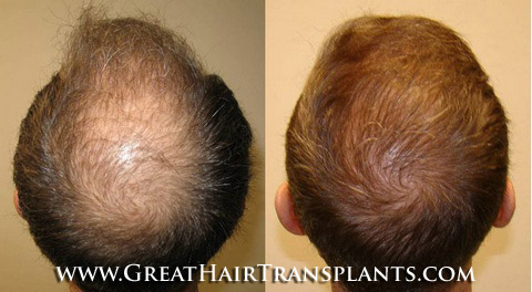 affordable hair transplants